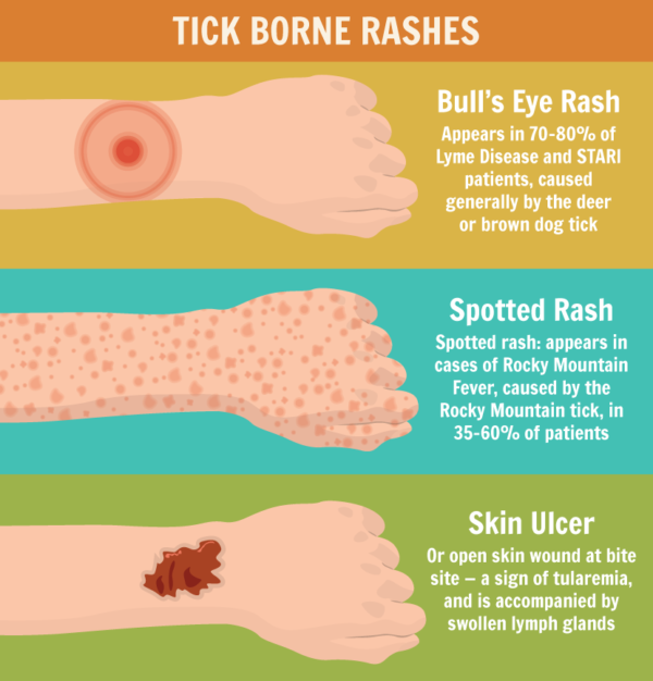 tick-borne-rashes - Karl McManus Foundation